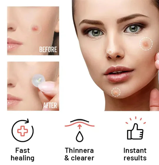 Miracle Chin Acne Repair Patch Day & Night (36/72 Patch Box)